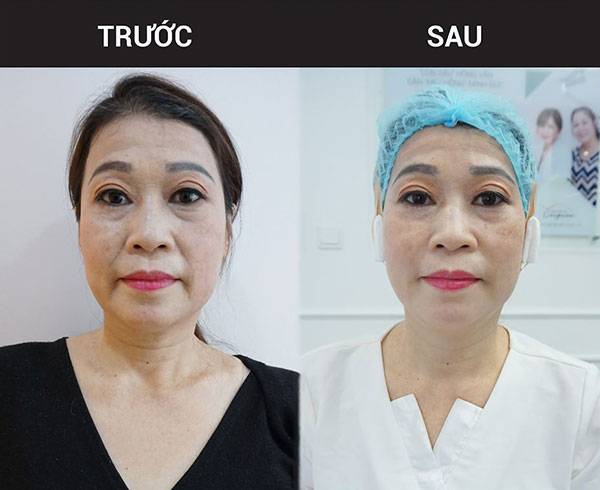 Nâng Cơ HIFU - Giải Pháp Làm Đẹp Hiện Đại Không Thể Bỏ Qua